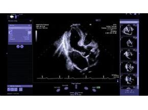 global, Cardiovascular Ultrasound Imaging Systems, market report, history and forecast, 2013-2025.jpg